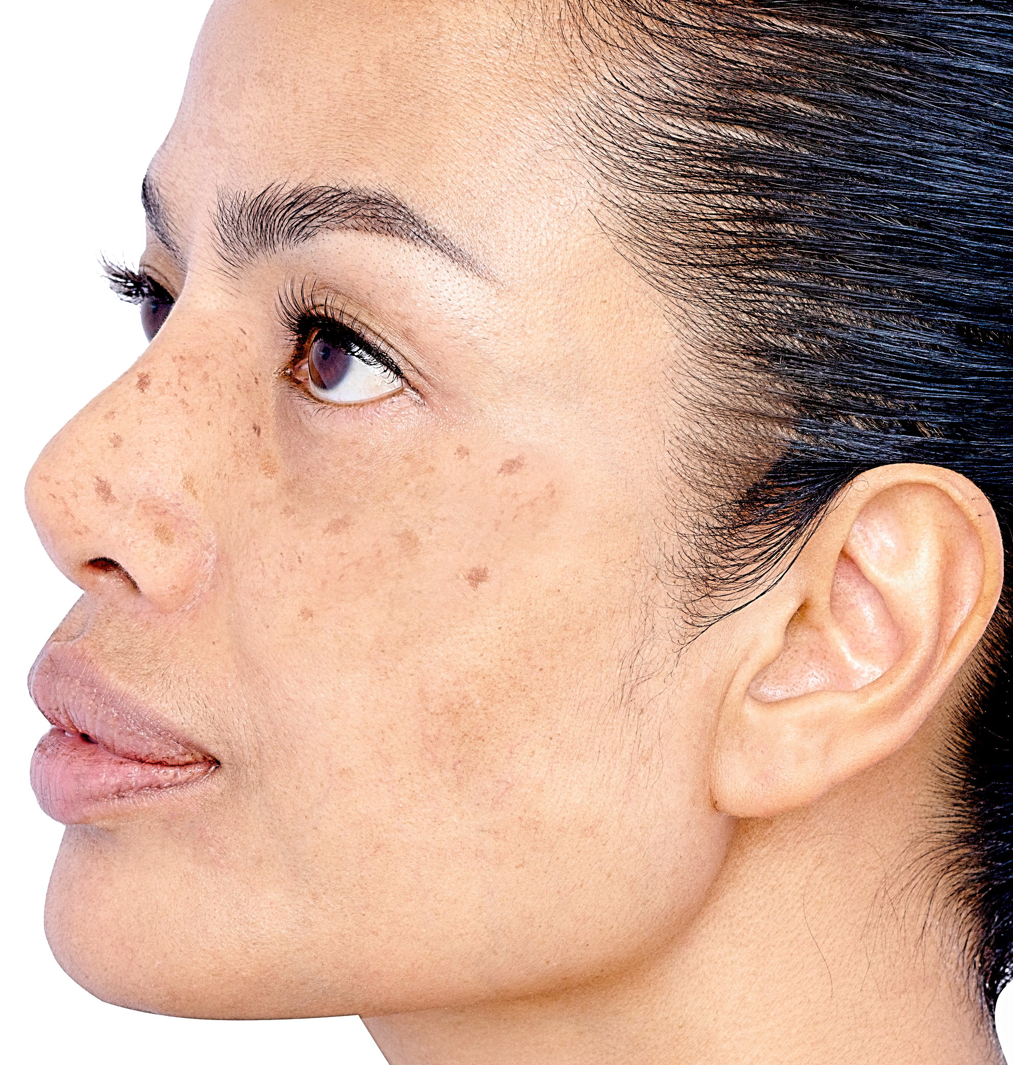Skin tone Before Treatment, Contact Skinz